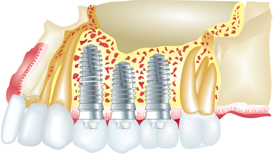Implantatversorgung