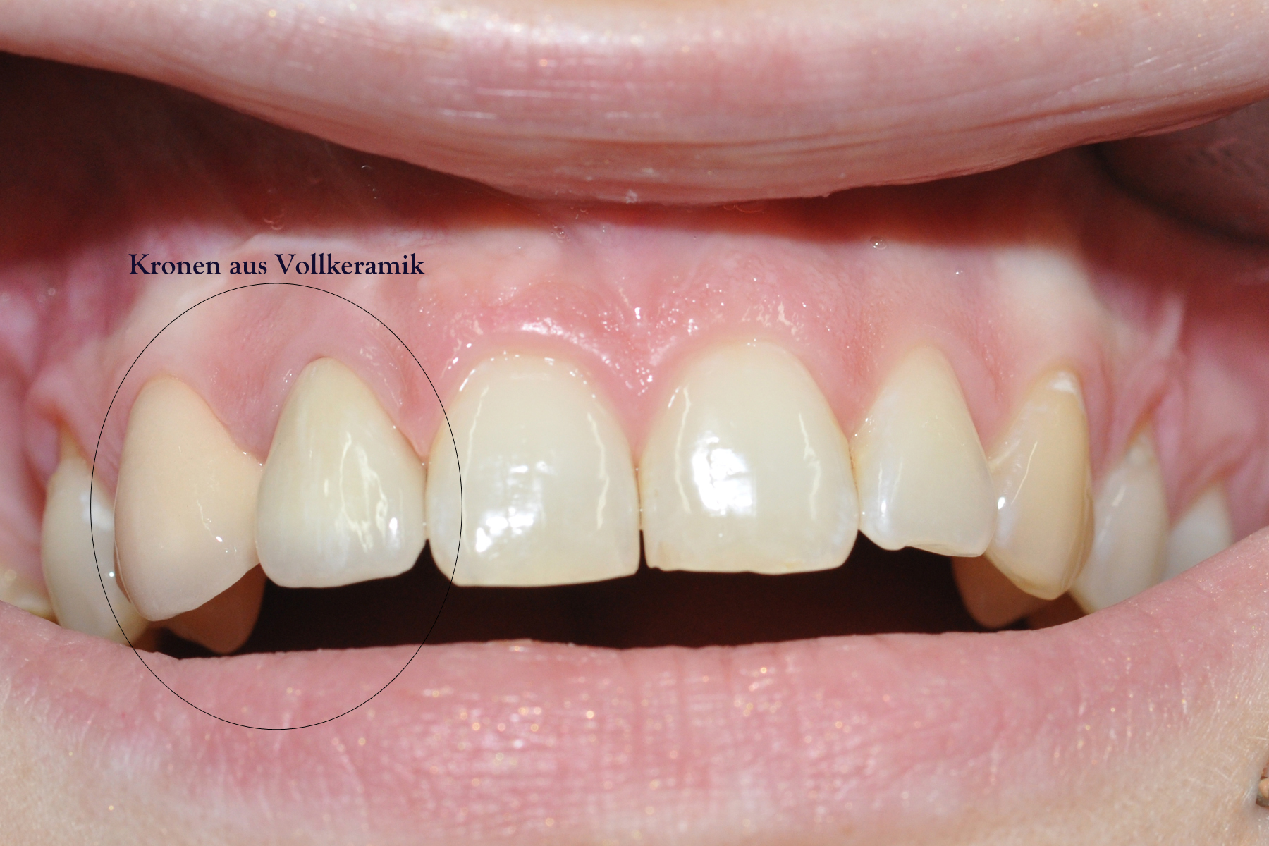 Vollkeramik Patient 2